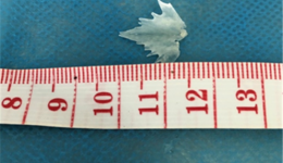 鱼刺卡喉别大意 及时就医是关键