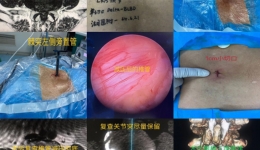 【卓越医疗在湖一】 湖医附一医院创新性开展湖南省首例腰椎管狭窄中线单切口内镜下BLBD术