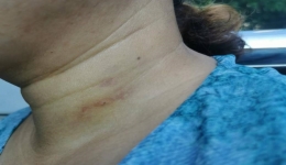 【卓越医疗在湖一】 超声引导下微波消融治疗，甲状腺结节患者的福音